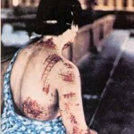 Queimadura radioativa "grave" - esta senhora teve parte do rosto, a nuca, as costas e o braço direito queimados pela radiação. Os raios atravessaram as áreas tingidas em tons escuros do quimono que ela usava no momento da explosão, "imprimindo" na pele os desenhos do tecido. Foto: Hiroshima Peace Memorial Museum