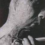 Quelóides - a pele queimada pela radiação não se cicatriza de forma lisa, como nomalmente ocorreria. Ela se cicatriza numa massa de pele enrugada e disforme chamada quelóide. Foto: Hiroshima Peace Memorial Museum